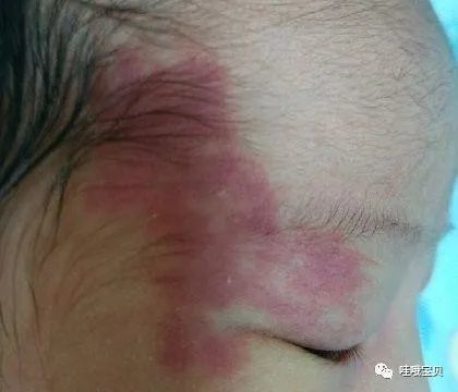 孩子身上有胎记?是怀孕这5个坏习惯埋下的"根"