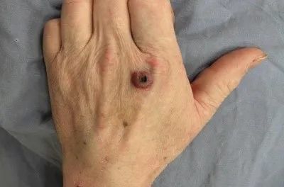 14岁学生死于可防可治的炭疽病背后的原因值得深思