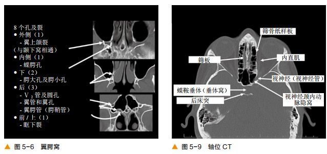 超清圖解鼻竇及顱底ct解剖