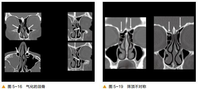 超清圖解鼻竇及顱底ct解剖