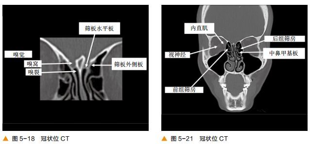 超清圖解鼻竇及顱底ct解剖