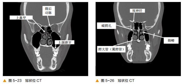 前後篩竇以中鼻甲基板為界,蝶竇及後組篩竇以上鼻甲基板為界.