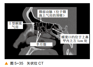 超清圖解鼻竇及顱底ct解剖