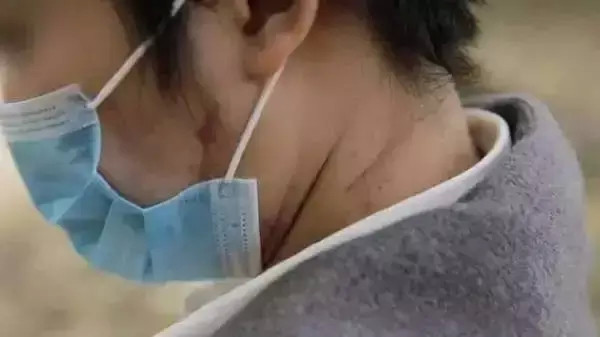 她保住了性命,但因为老虎在脸上留下的撕咬伤口太大,赵菁痊愈后脸上留