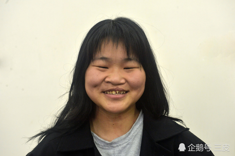 兔唇女孩因长相太丑出生被妈妈遗弃如今换脸成功容貌似明星
