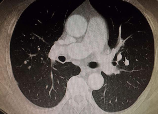 44岁大姐查出7mm肺结节,半年结节逐渐消失,医生:方法值得借鉴