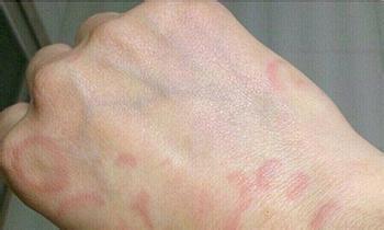 动物毛发,花粉,寄生虫等等,然而现实生活中也有一些比较奇葩的过敏原