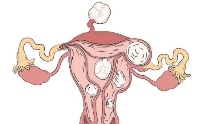 有子宮肌瘤的女人若身體出現6種表現需要及時就醫別大意