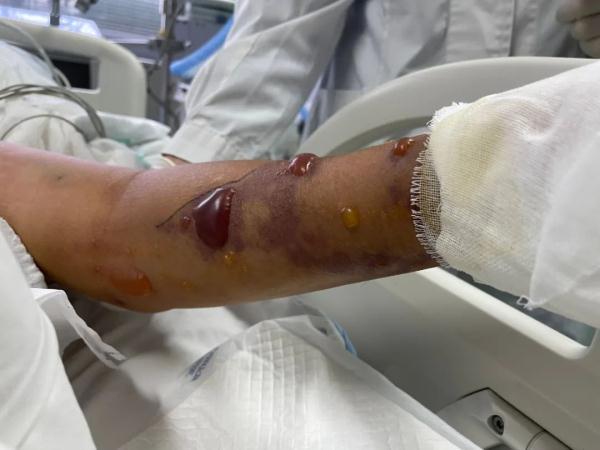 老人洗了一条鱼,竟然进了icu!医生:"立即截肢,否则性命不保!