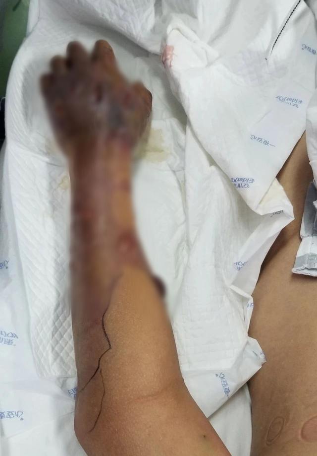 男子洗鱼后,手上全是大水泡!医生:立即截肢保命!