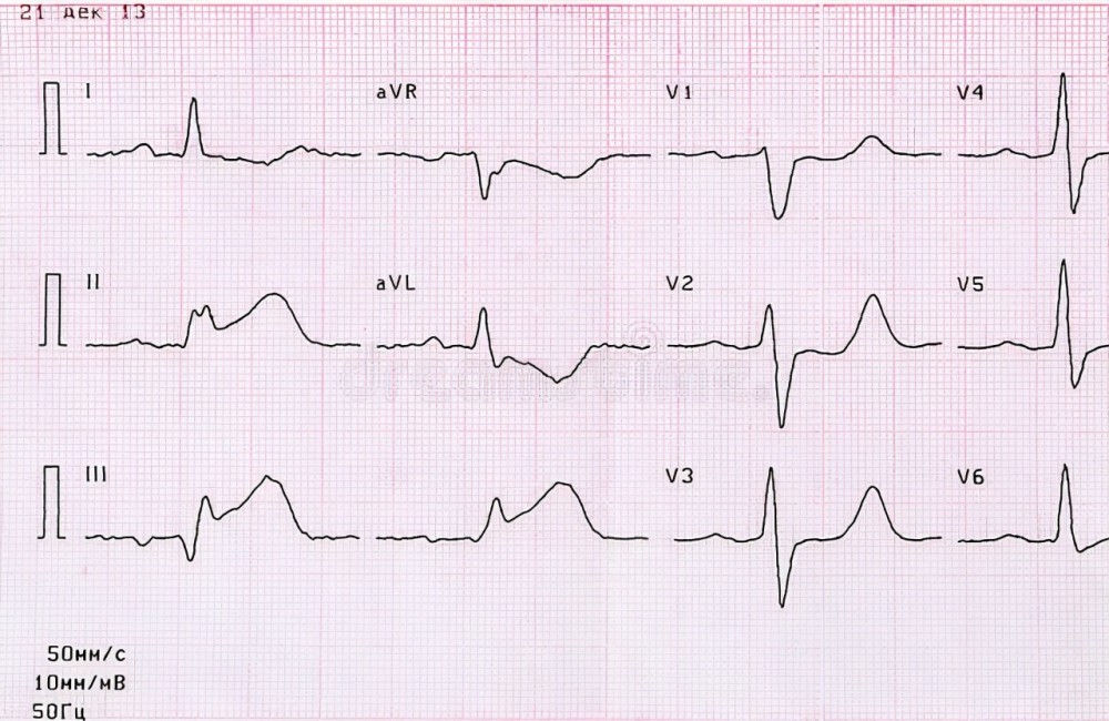 图写着:窦性心律,ST段改变T波倒置。是