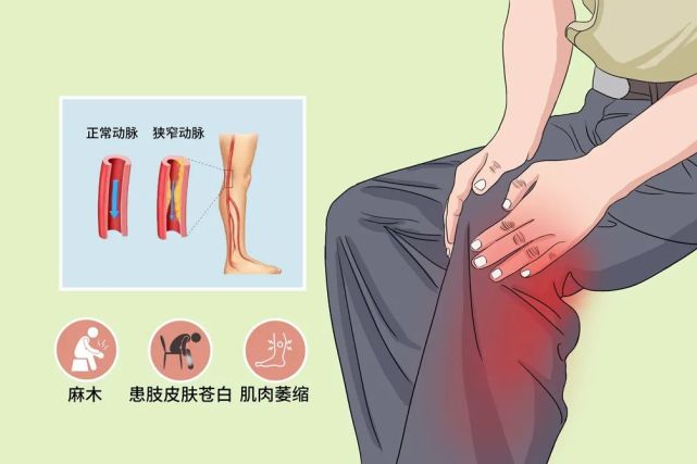 关注健康关注下肢动脉硬化闭塞症