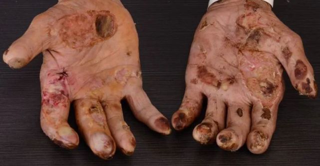 被忽视e要素的poems综合征