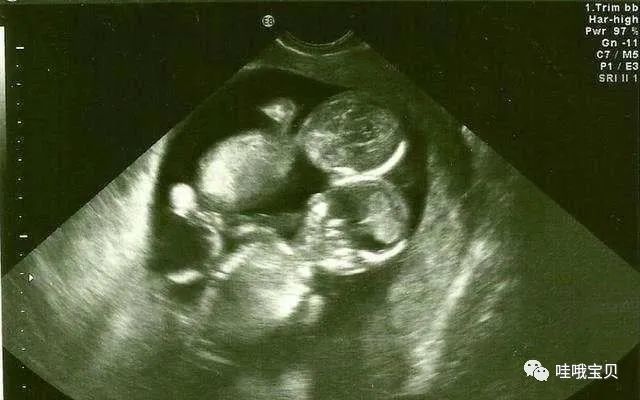 产检胎儿是连体婴医生建议引产妈妈坚持生下宝宝后惊喜不已