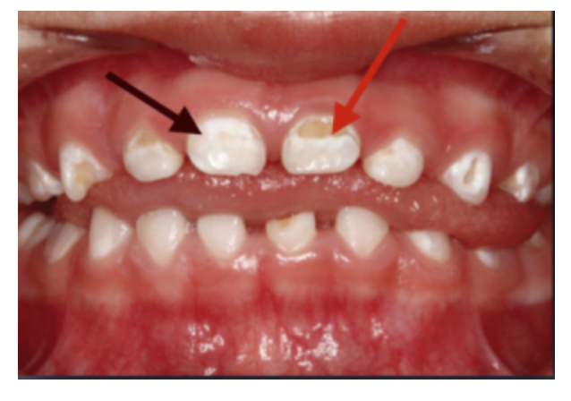真讨厌娃牙齿上的黑斑去也去不掉