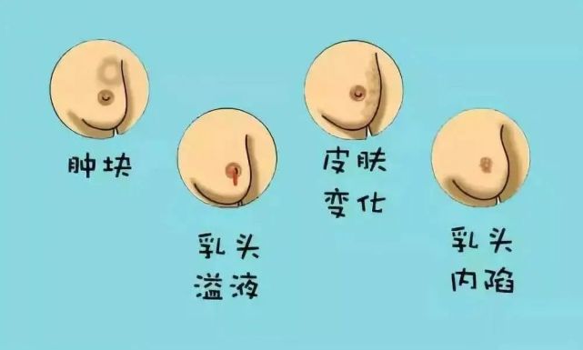 乳头溢液可以是血性,浆液性,水样,乳汁样的.