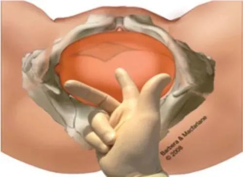 不均倾位产程中常被忽略的一种胎位