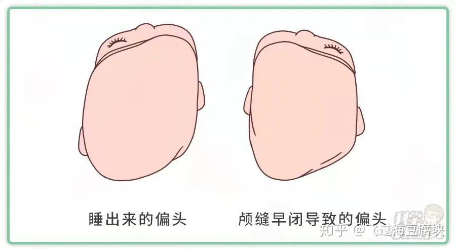 颜值提升预防宝宝偏头