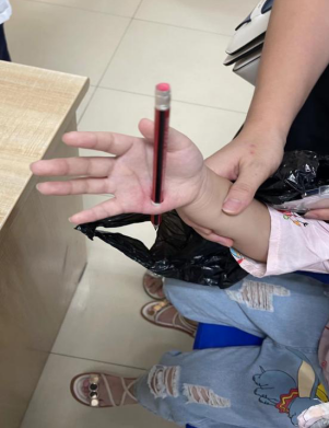 厦门一年级女孩写作业,被铅笔刺穿手心