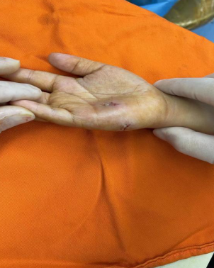 家长吓惨了厦门一年级女孩写作业被铅笔刺穿手心