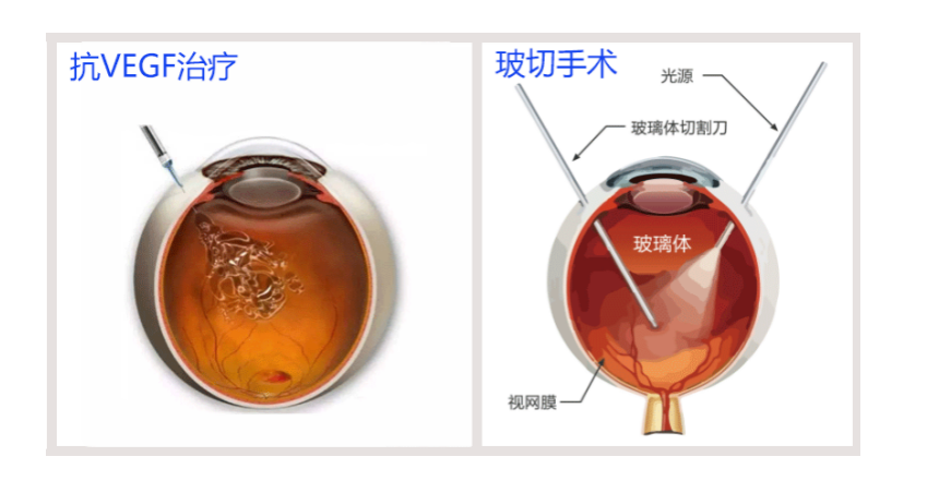 玻璃体切割硅油填充术图片