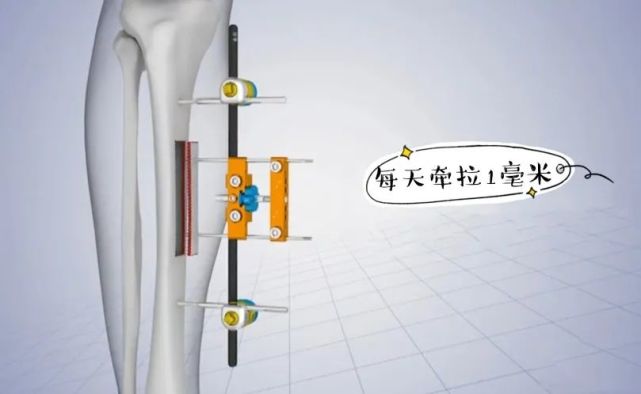 骨搬移手术原理图图片