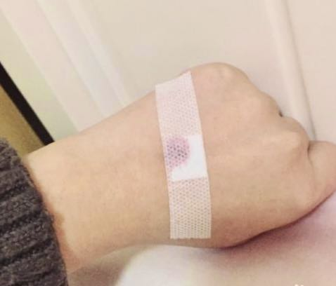 淤青|针眼|血管|输液