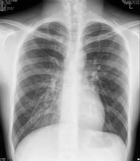 不发热,不咳嗽,x线报告咋就"肺纹理增多,增粗"了呢?