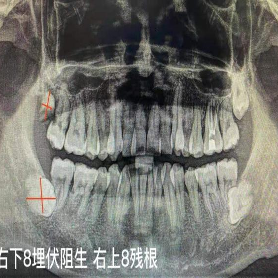 阻生齒這個磨人的小妖精