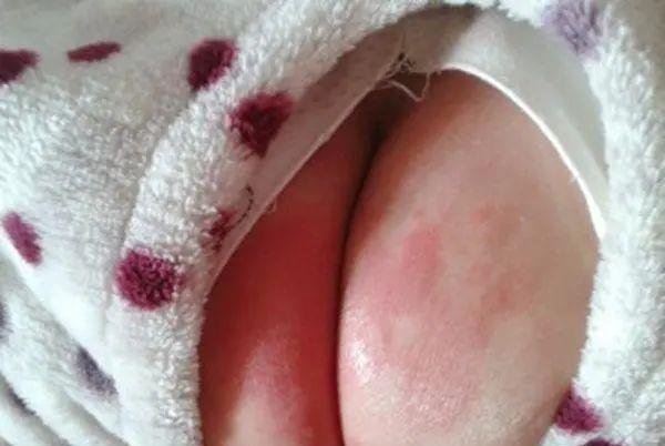 8个月宝宝脊柱受伤,只因妈妈换纸尿裤时的一个动作!