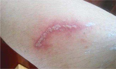 硫酸蚂蚁是怎样的一种生物该如何预防呢