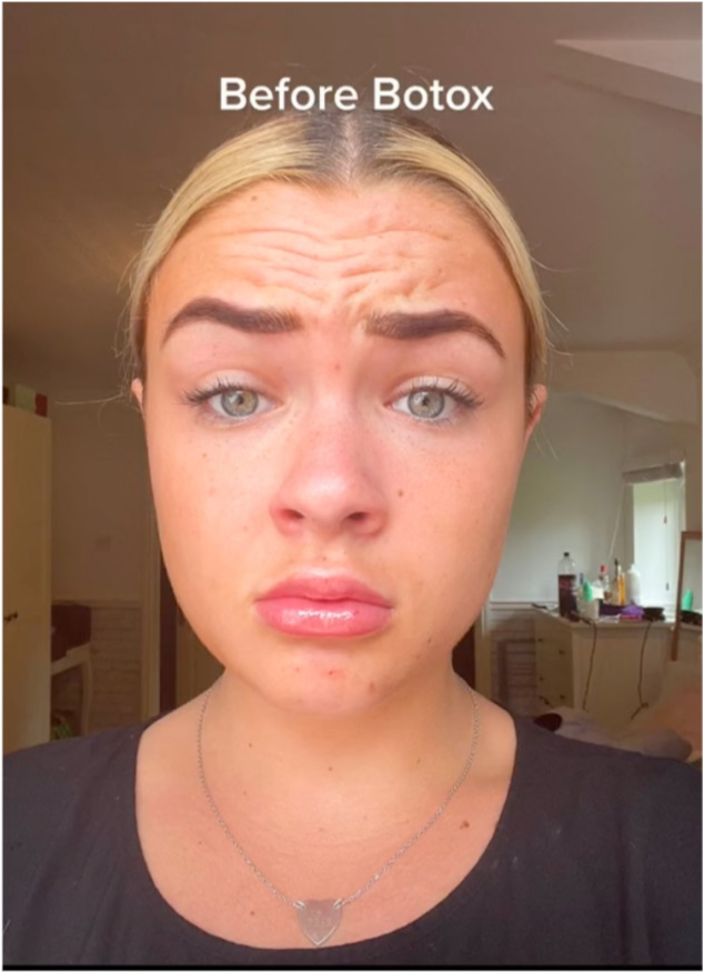 外国女孩展示打肉毒杆菌前后照片,效果明显,却被评价从20岁变成30