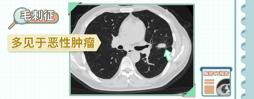 一看大小二看形态两招判断肺结节的良恶性