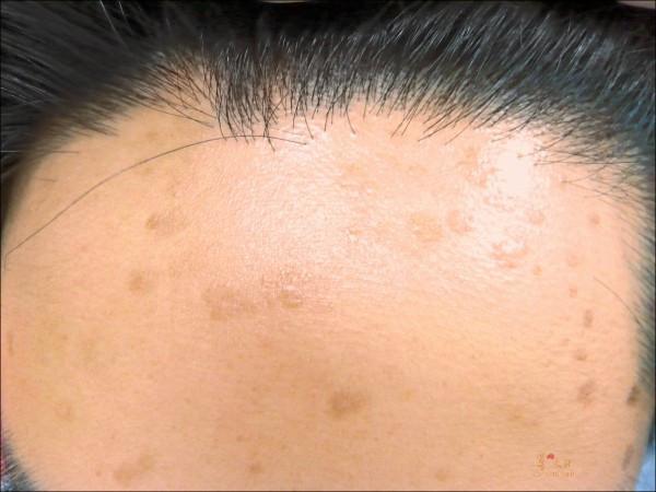 皮肤上的小肉球是什么?多半是这几种东西,要清楚