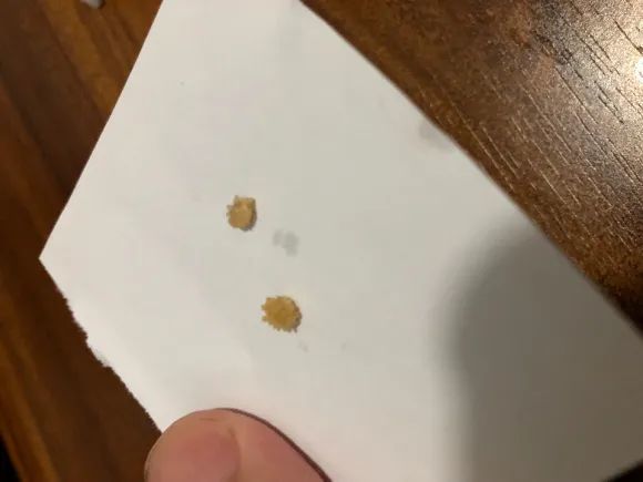 2天排出肾结石 腾讯网