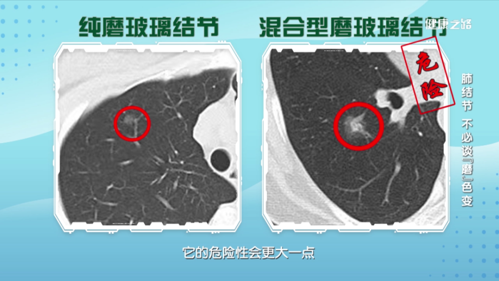 什麼是磨玻璃結節?