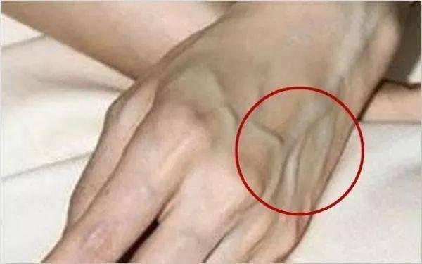 还有一些人认为,如果手背上的青筋长期处于这样一个状态,很容易会影响