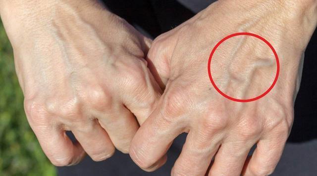 为啥有的人手上的青筋会凸出来?青筋越多,对身体有什么影响?