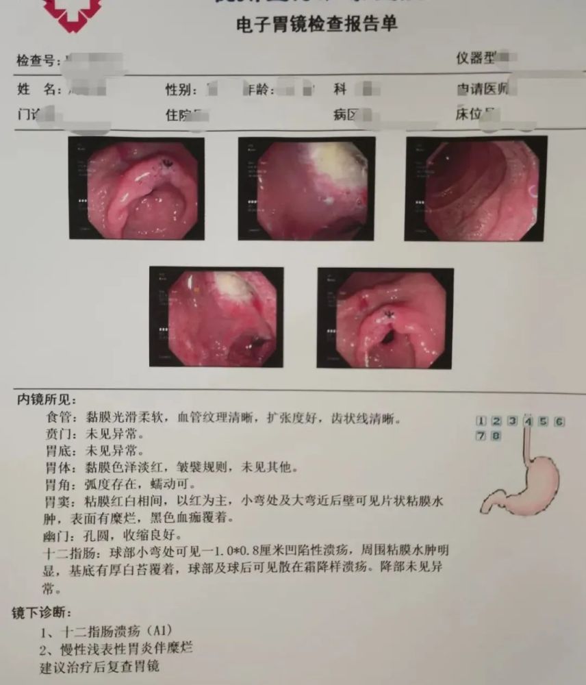 溃疡出现在屏幕上,医生表示:这已经很严重了,再继续喝下去要胃穿孔的