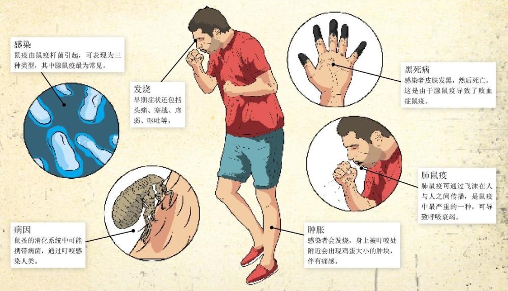 一般表现为淋巴腺发炎,所以通常也称为淋巴腺鼠疫