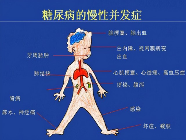 錯誤使用二甲雙胍,導致糖尿病急性併發症?這個錯咱們要避開