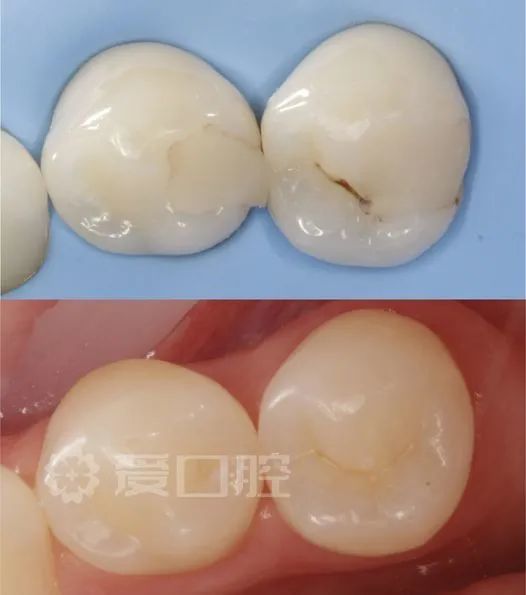 30組補牙前後照欣賞