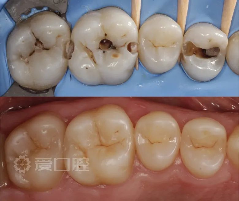 補牙也是門藝術活兒30組補牙前後照欣賞