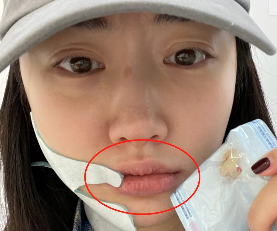 景甜拔牙后脸部肿一半牙齿上粘连血迹素颜双眼皮褶子不太自然