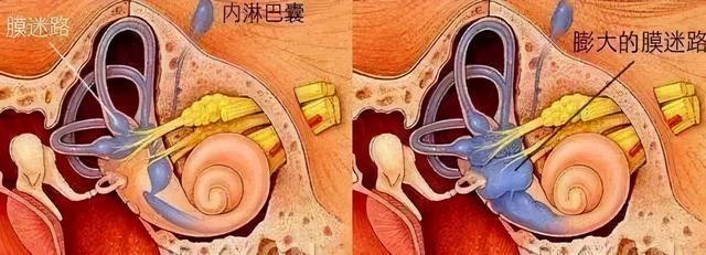 的耳源性眩晕疾病,其发病机制尚不明确,主要的病理改变为膜迷路积水