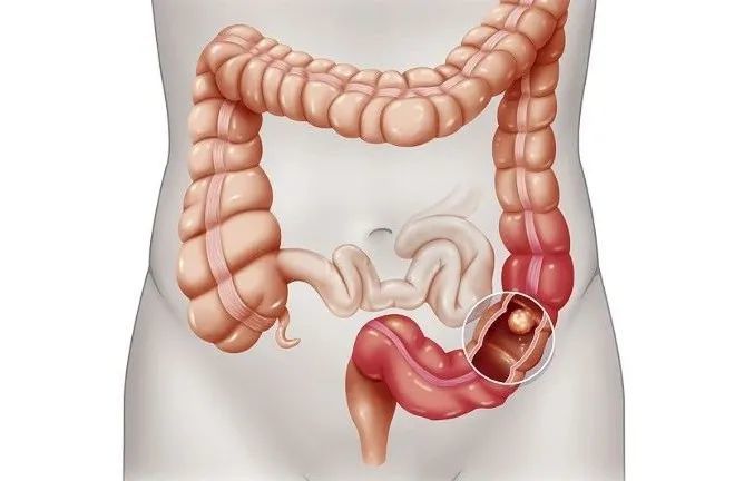 结肠位置图图片