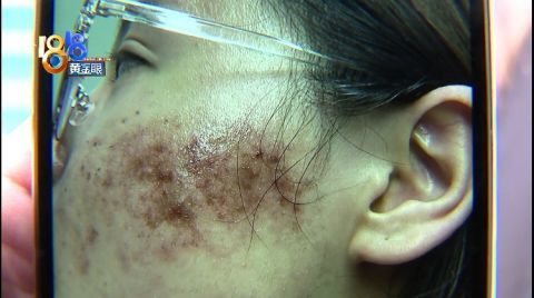 光子嫩肤脸上结痂聚美认为情况正常