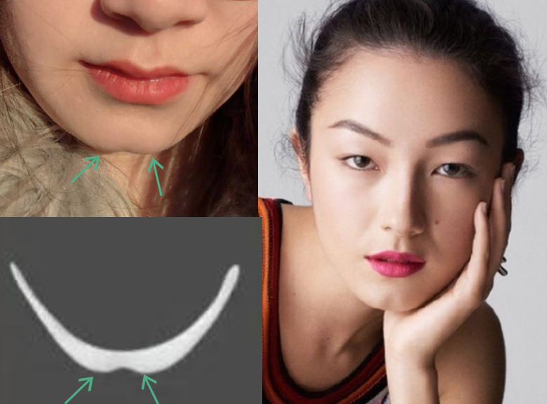 如果方下巴中间有道沟,俗称屁股下巴, 左右两处表现点则更加明显.