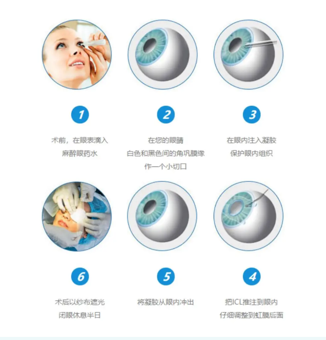 兰州爱尔实用科普 | ICL晶体植入具有“可逆性”，到底是个啥？(图1)