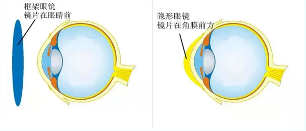 兰州爱尔实用科普 | ICL晶体植入具有“可逆性”，到底是个啥？(图2)